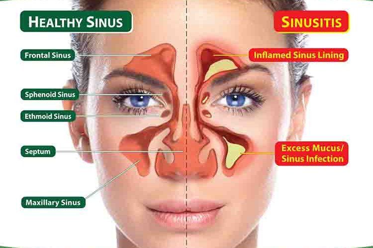 sinus