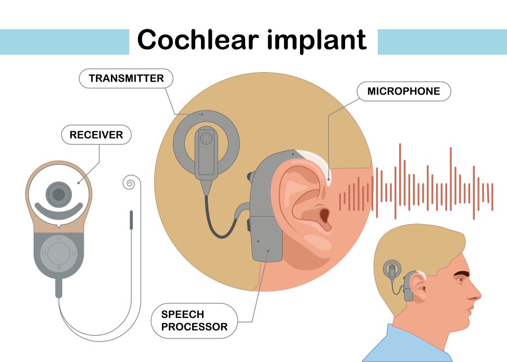 Cochlear Implants